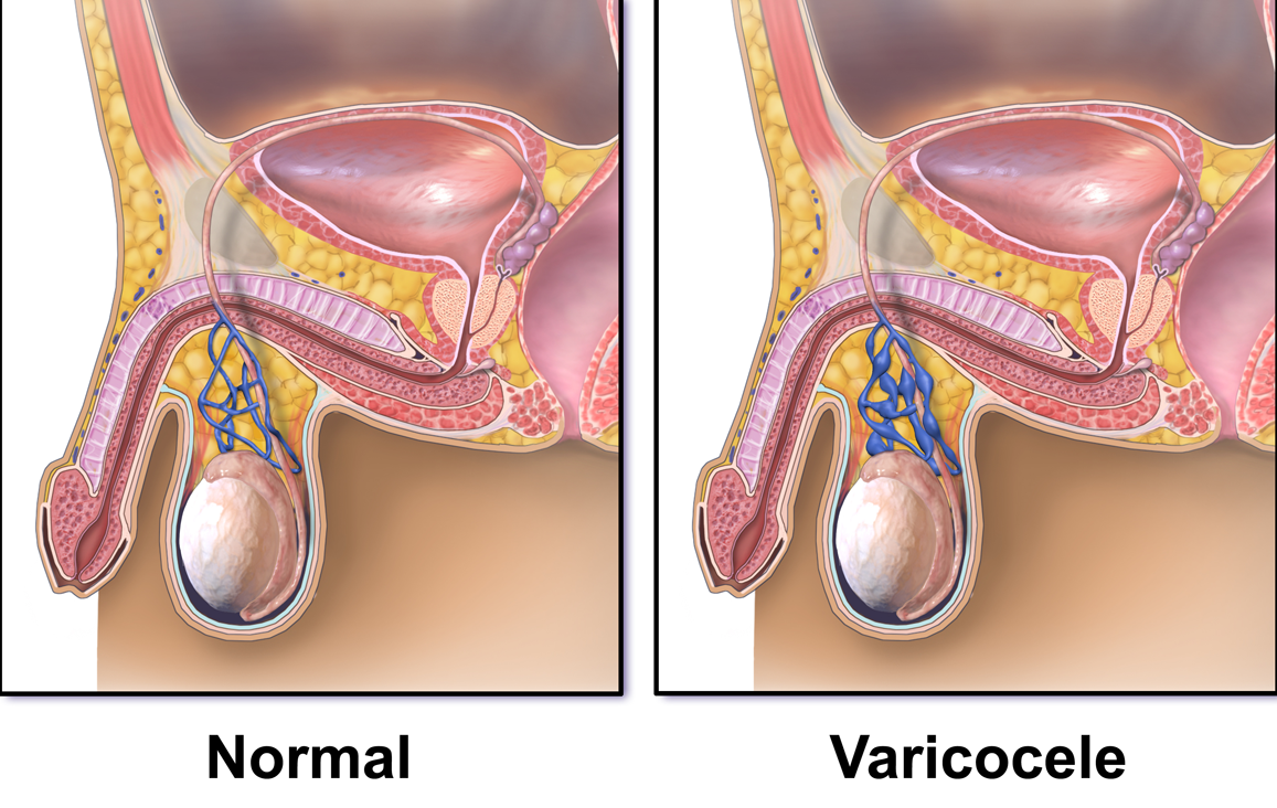 MaAx Super Speciality Hospital on X: Varicocele embolization is a